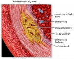 gambar arteri koroner