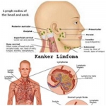 kanker Limfoma